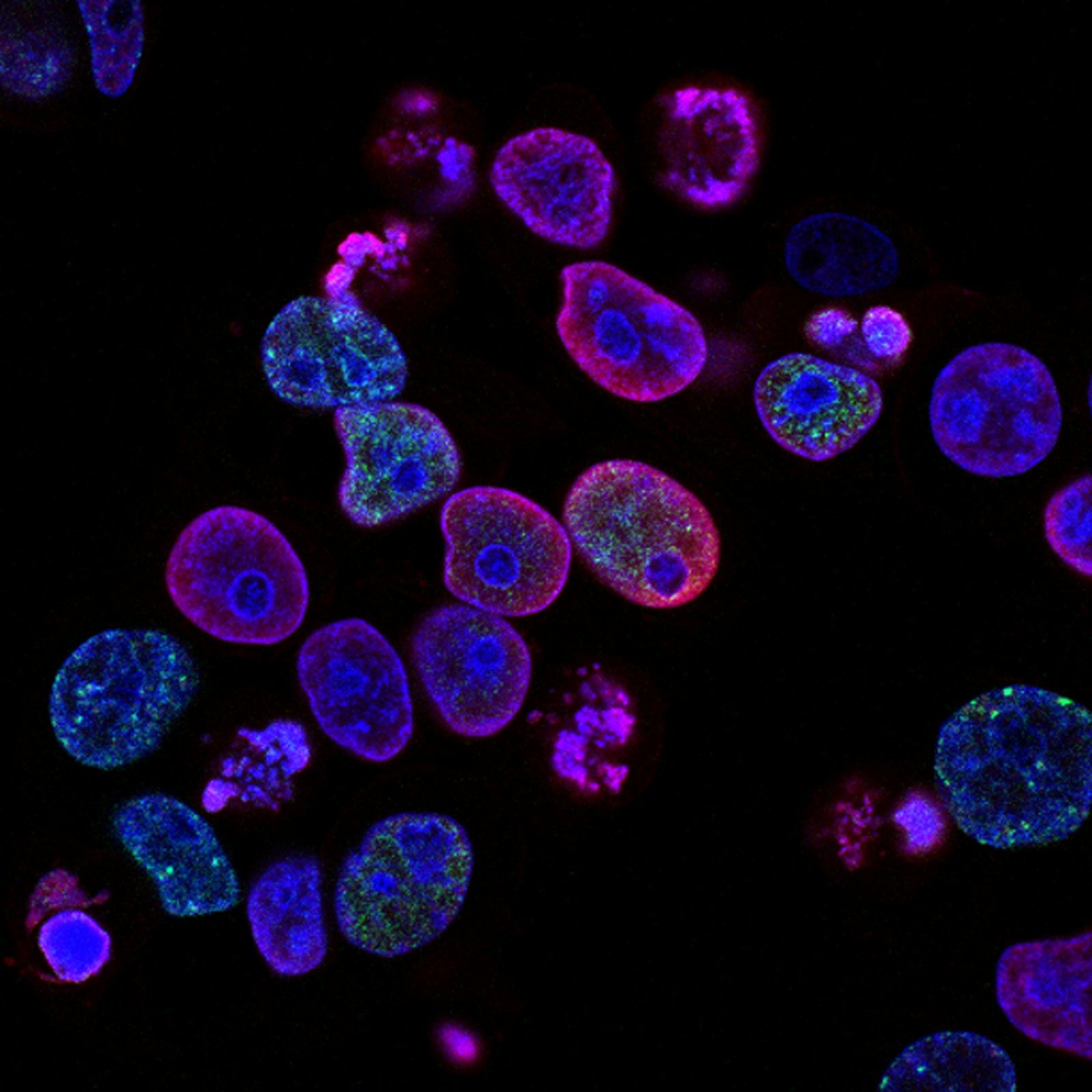 Purple-toned microscopy of senescent zombie cells contributing to chronic skin inflammation and aging